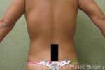 Liposuction - Case 68 - After