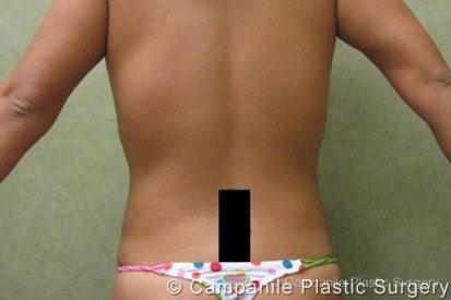 Liposuction Patient Photo - Case 68 - after view