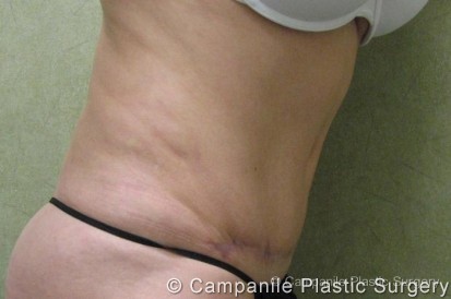 C.L.A.S.S.™ Tummy Tuck Patient Photo - Case 21 - after view