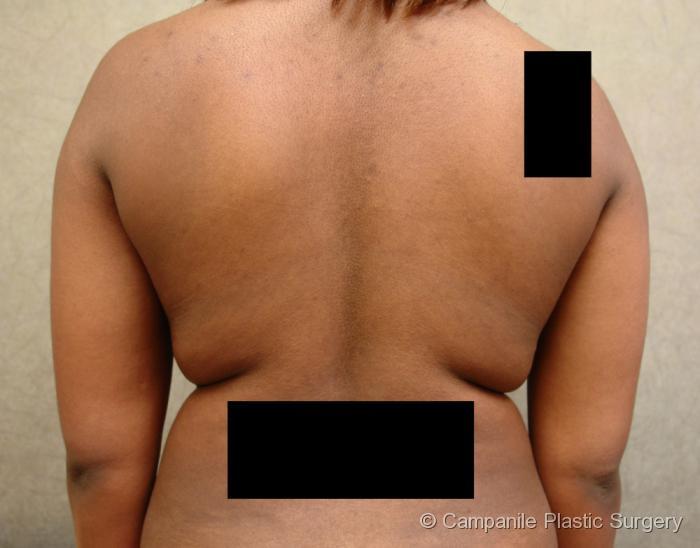 Liposuction Patient Photo - Case 73 - before view-