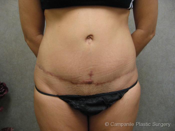 Tummy Tuck Revision Patient Photo - Case 52 - before view-