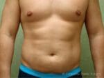 Liposuction - Case 74 - Before