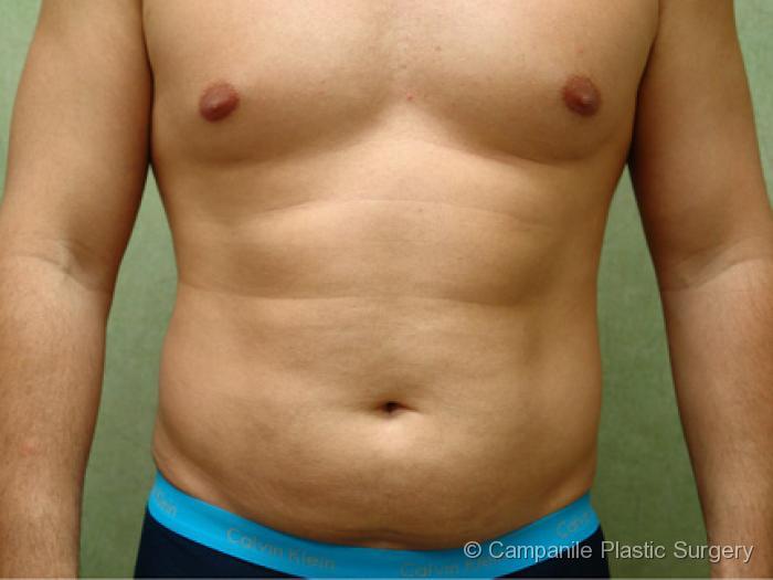 Liposuction Patient Photo - Case 74 - before view-
