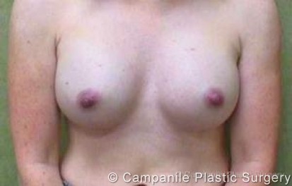 Breast Augmentation Patient Photo - Case 198 - after view