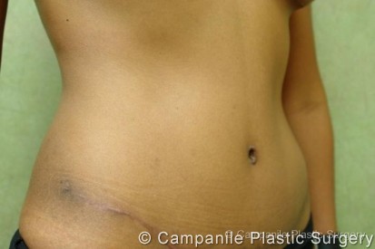 Tummy Tuck Patient Photo - Case 39 - after view-1