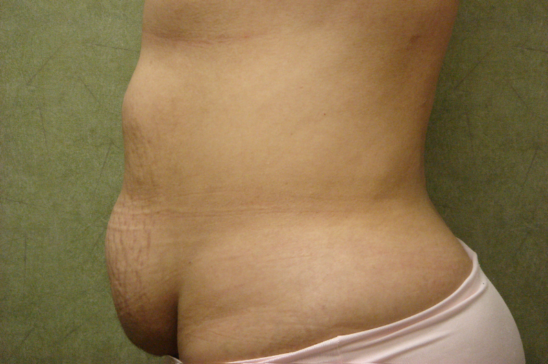 C.L.A.S.S.™ Tummy Tuck Patient Photo - Case 220 - before view-1