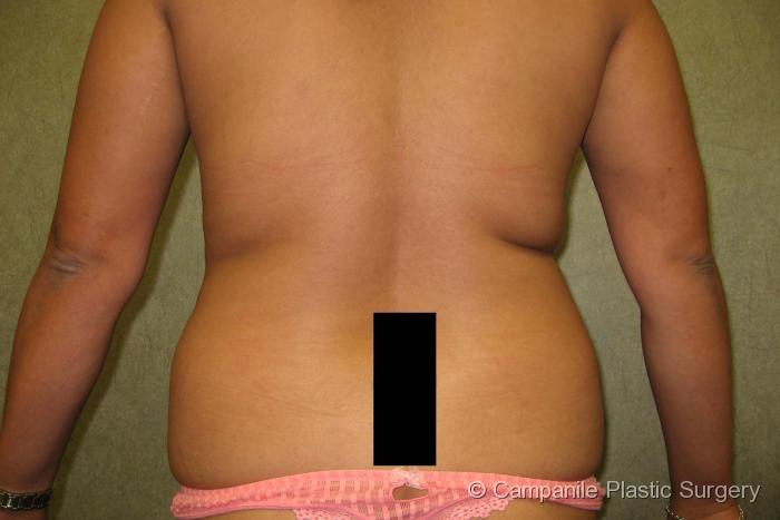 Liposuction Patient Photo - Case 68 - before view-