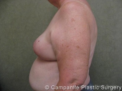 Breast Reduction Patient Photo - Case 172 - after view-1