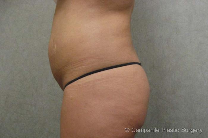Mini Tummy Tuck Patient Photo - Case 47 - before view-