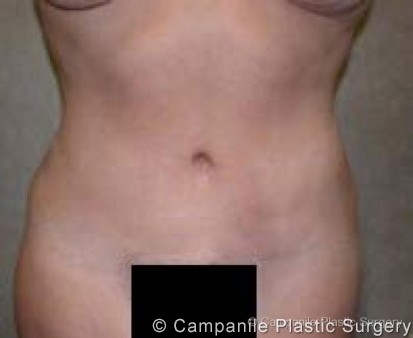 C.L.A.S.S.™ Tummy Tuck Patient Photo - Case 29 - after view-0