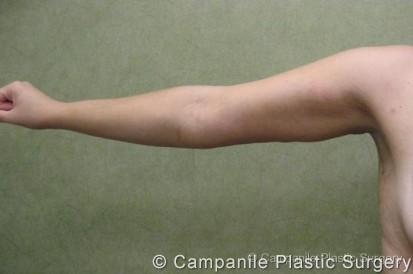 Arm Lift Patient Photo - Case 79 - after view
