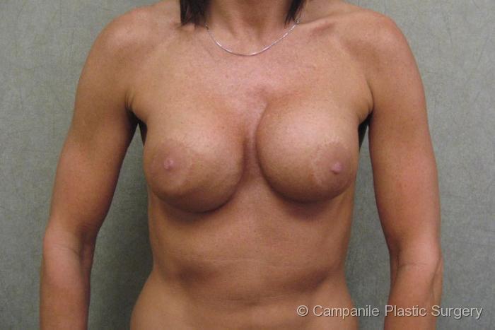 Breast Surgery Revision Patient Photo - Case 182 - before view-