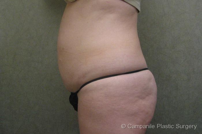 C.L.A.S.S. Tummy Tuck™ Patient Photo - Case 35 - before view-1