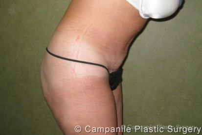 C.L.A.S.S.™ Tummy Tuck Patient Photo - Case 18 - after view