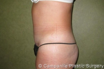 Tummy Tuck Patient Photo - Case 35 - after view-1