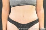 C.L.A.S.S.™ Tummy Tuck - Case 295 - After