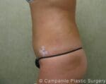 Liposuction - Case 213 - After