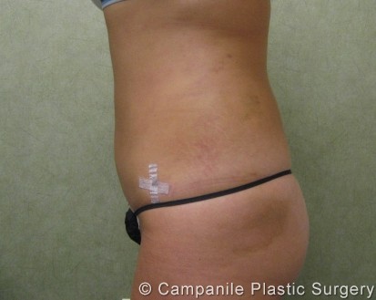 Liposuction Patient Photo - Case 213 - after view