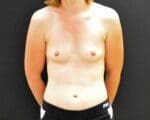 Breast Augmentation - Case 334 - Before