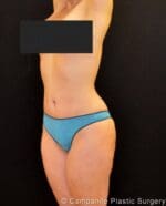 C.L.A.S.S.™ Tummy Tuck - Case 343 - After