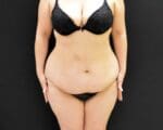 After Massive Weight Loss - Case 345 - Before