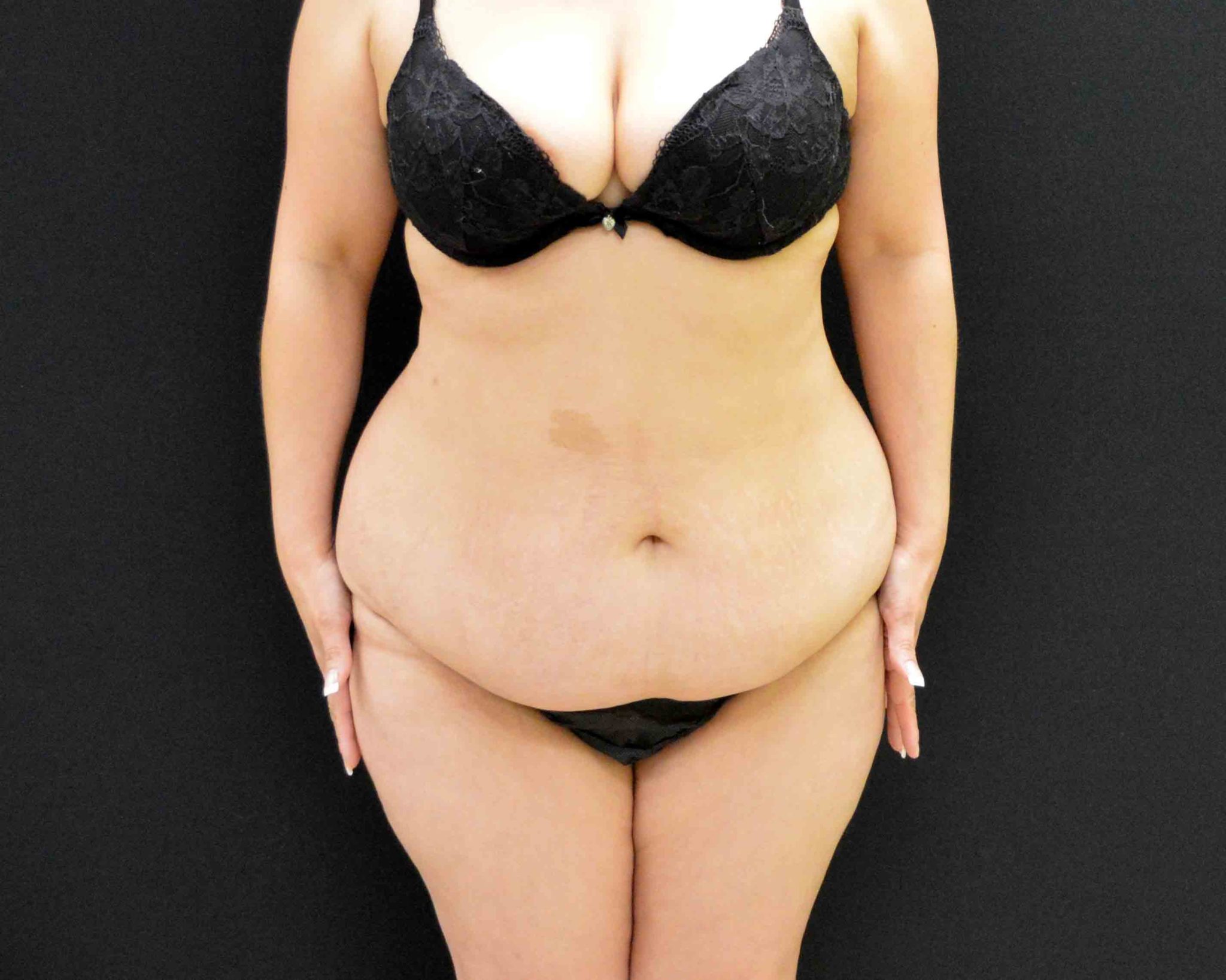 After Massive Weight Loss Patient Photo - Case 345 - before view-