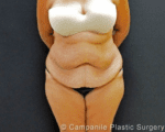 C.L.A.S.S.™ Tummy Tuck - Case 353 - Before