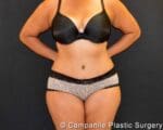 C.L.A.S.S.™ Tummy Tuck - Case 353 - After
