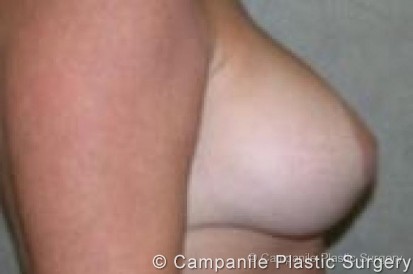 Breast Lift Patient Photo - Case 158 - after view