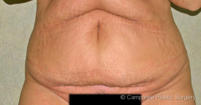 C.L.A.S.S.™ Tummy Tuck Patient Photo - Case 28 - before view-