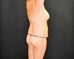 Liposuction - Case 364 - Before