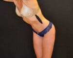 C.L.A.S.S.™ Tummy Tuck - Case 373 - After