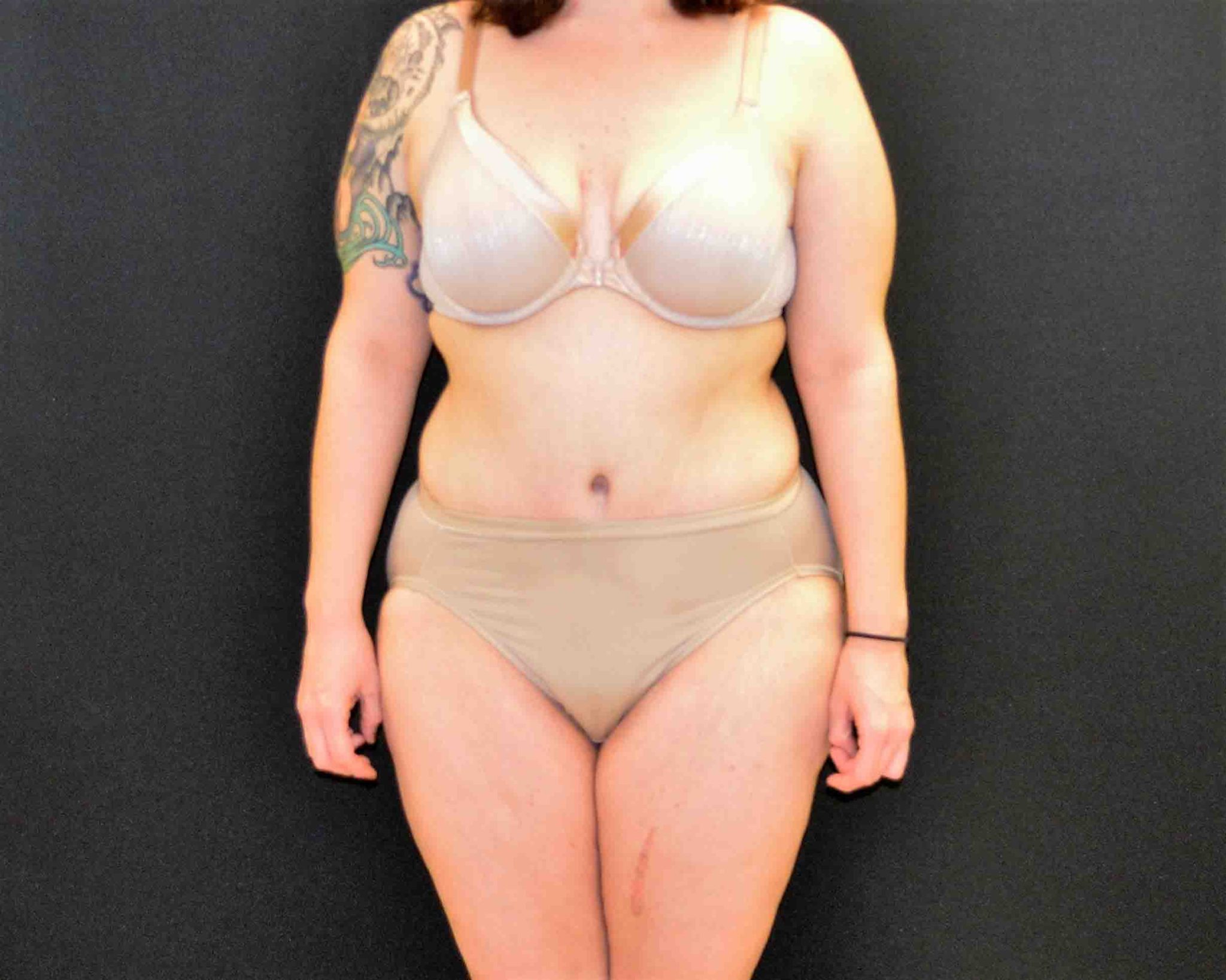 After Massive Weight Loss Patient Photo - Case 374 - after view