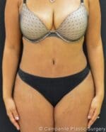 C.L.A.S.S.™ Tummy Tuck - Case 261 - After