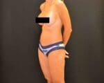 C.L.A.S.S.™ Tummy Tuck - Case 384 - After