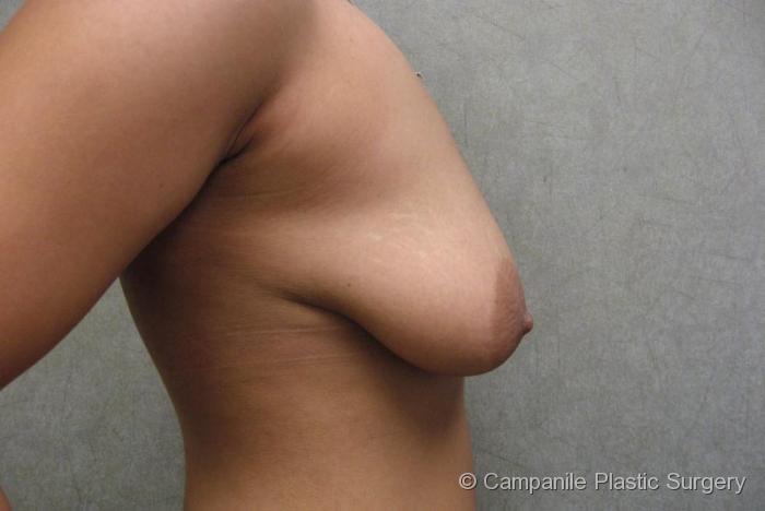 Breast Lift with Augmentation Patient Photo - Case 195 - before view-1