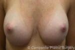Breast Augmentation - Case 153 - After
