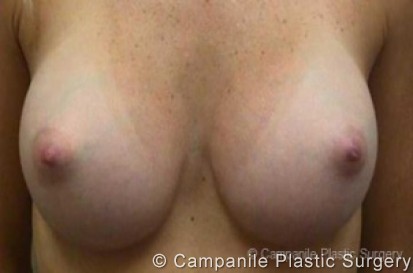 Breast Augmentation Patient Photo - Case 153 - after view