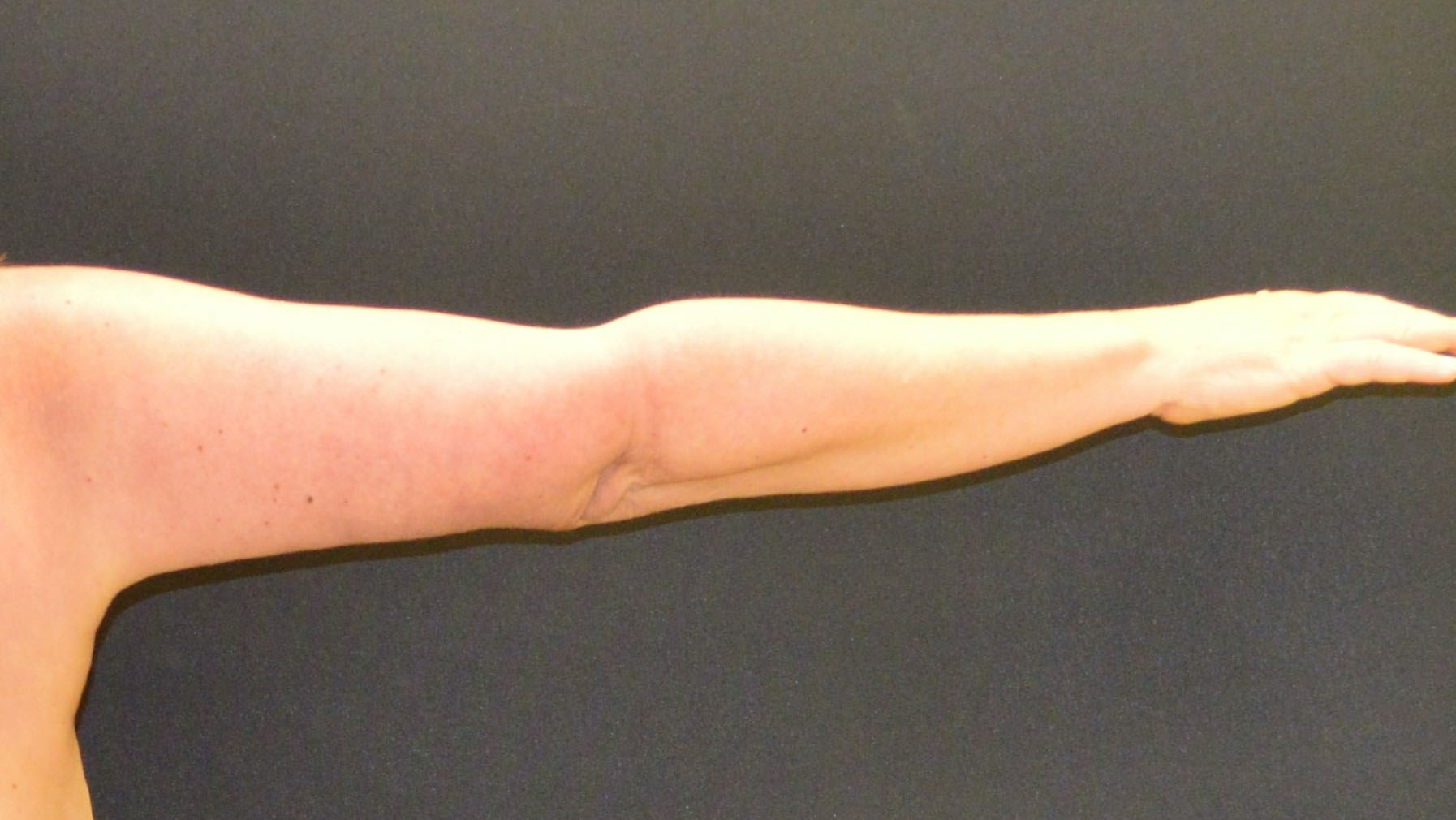 Arm Lift Patient Photo - Case 388 - after view