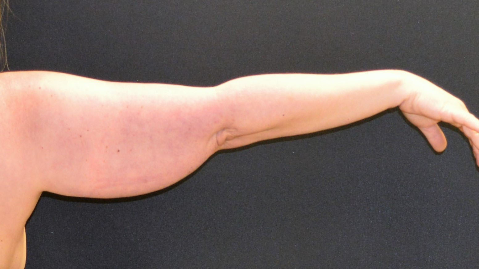 Arm Lift Patient Photo - Case 388 - before view-