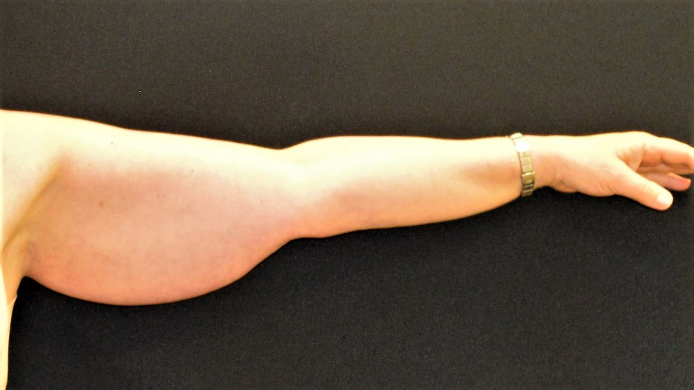 Arm Lift Patient Photo - Case 389 - before view-
