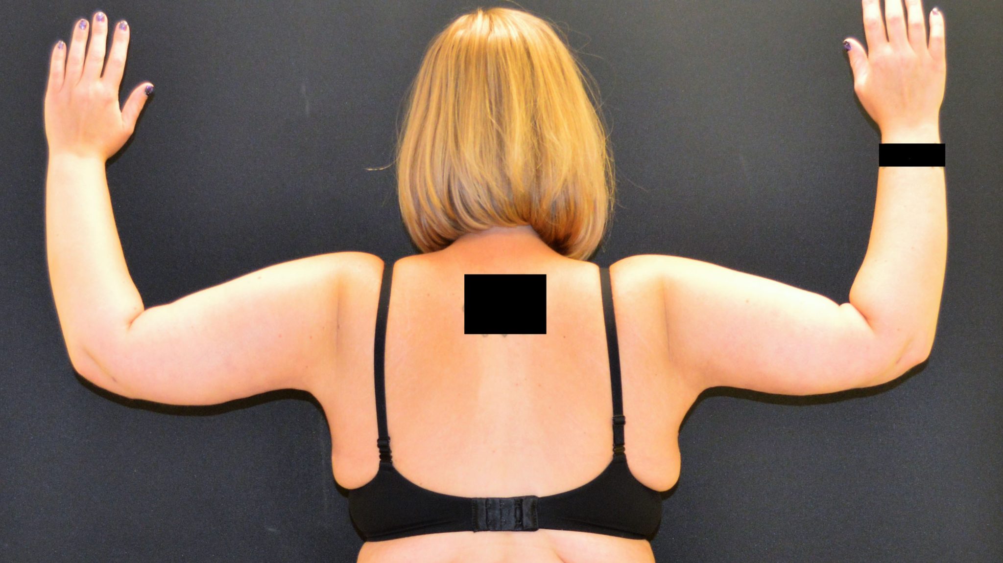 Arm Lift - Case 408 - After