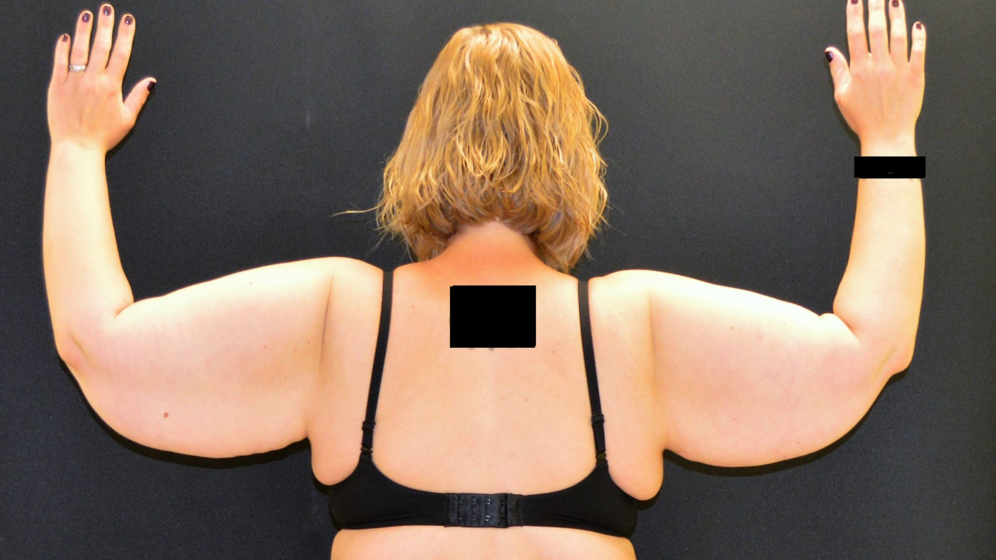 After Massive Weight Loss Patient Photo - Case 408 - before view-