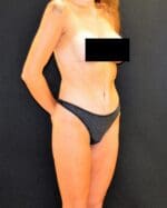C.L.A.S.S.™ Tummy Tuck - Case 427 - After
