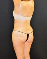 Liposuction - Case 431 - After