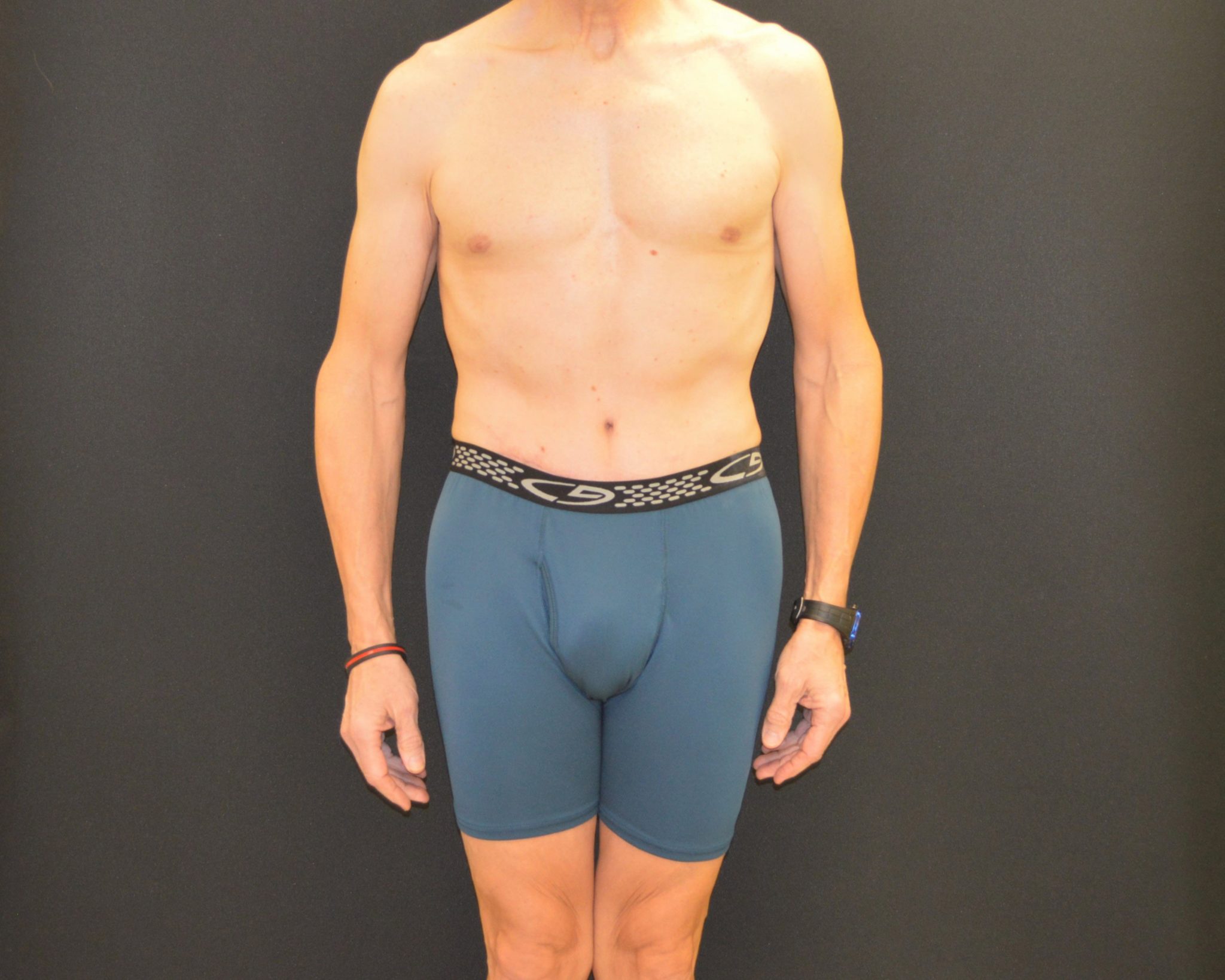 C.L.A.S.S. Tummy Tuck™ - Case 441 - After