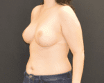 Breast Reduction - Case 448 - After