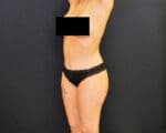 C.L.A.S.S.™ Tummy Tuck - Case 450 - After