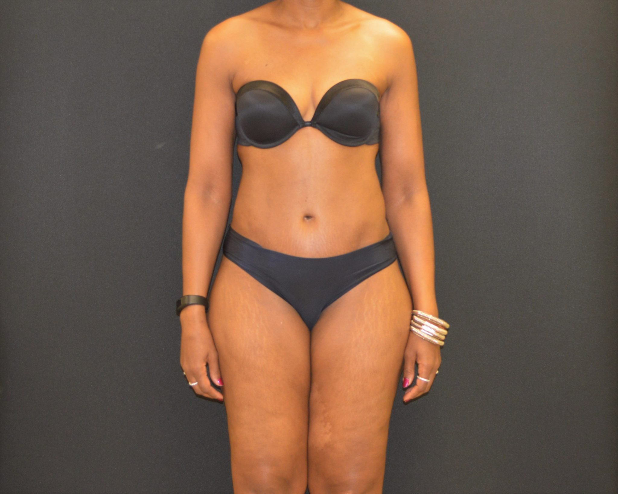 C.L.A.S.S. Tummy Tuck™ - Case 454 - After