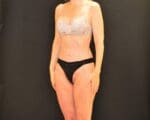 C.L.A.S.S.™ Tummy Tuck - Case 458 - After